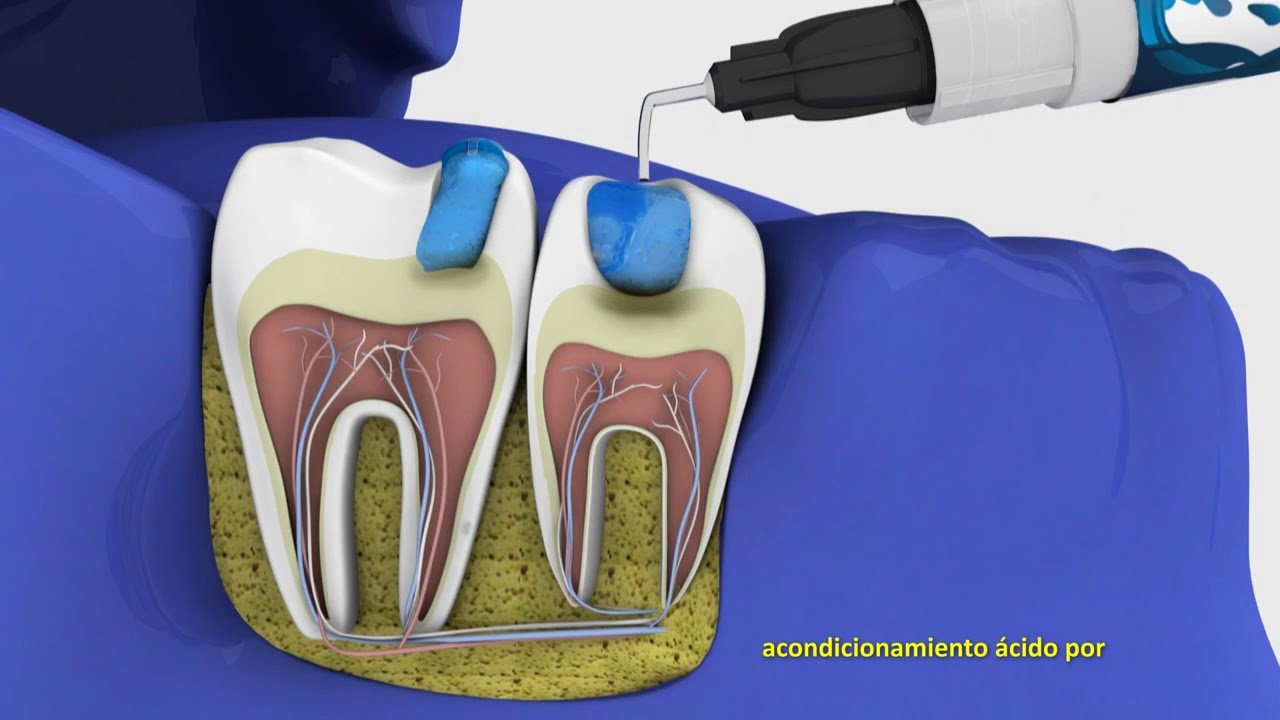 Oligómero de Hidroxiapatita de Calcio Fotopolimerizable: Innovaciones en Materiales Biomédicos